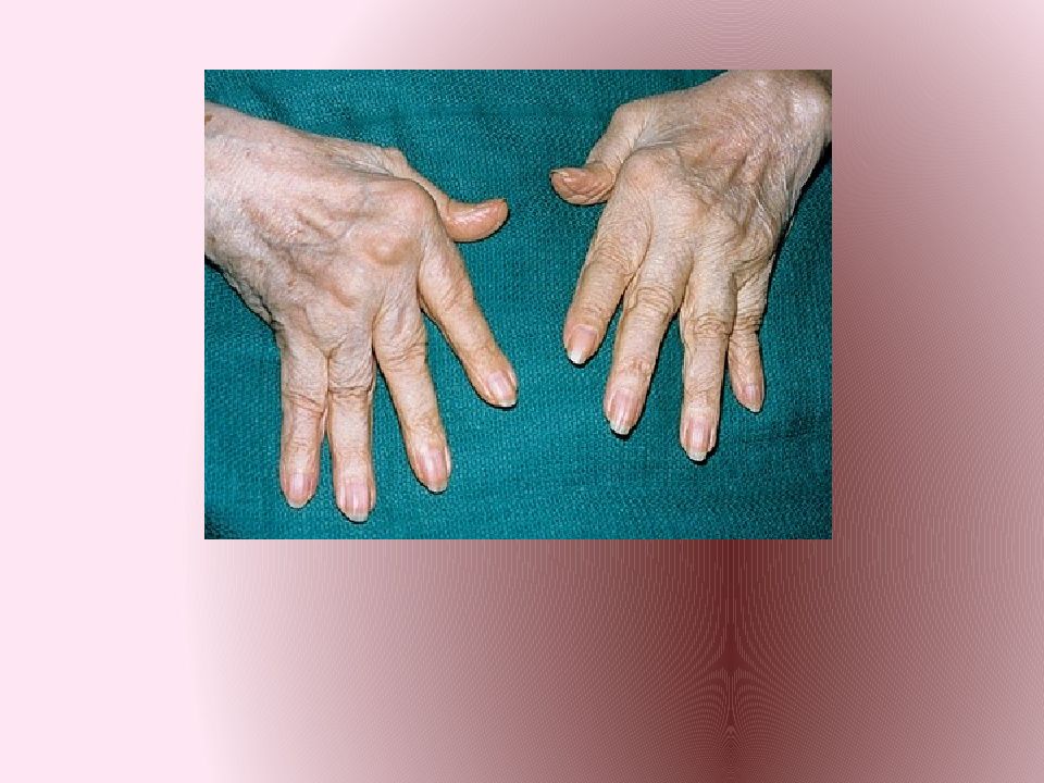 Ревматоидный Артрит Пальцев Рук Диета