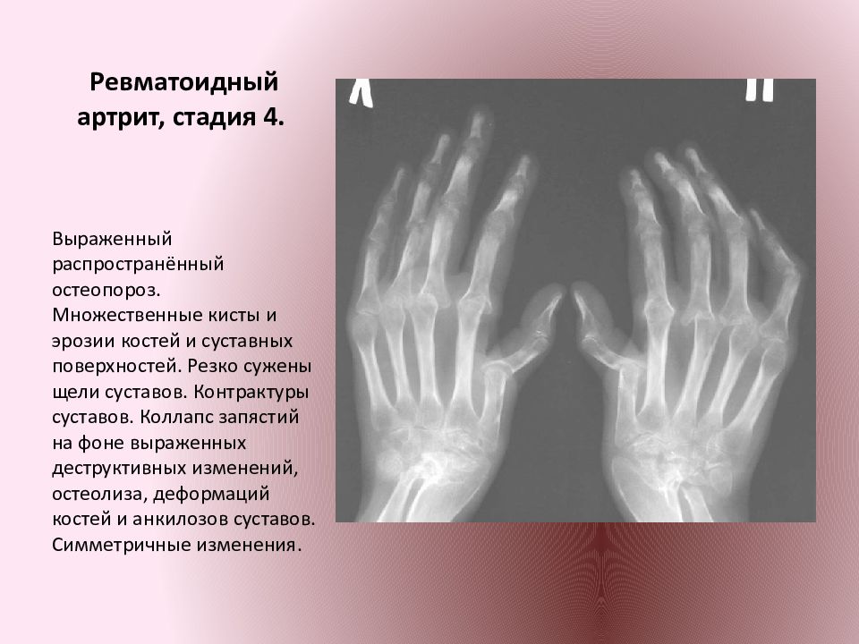 Ревматоидный Артрит Пальцев Рук Диета