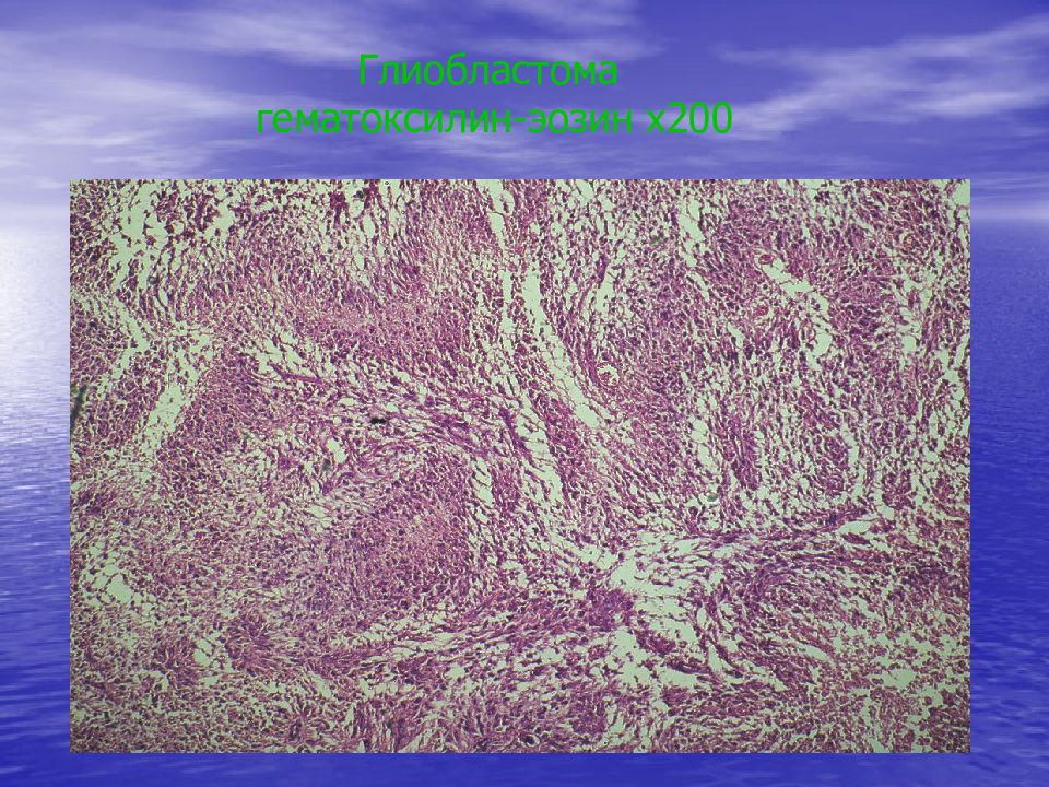 Глиобластома гематоксилин-эозин х200