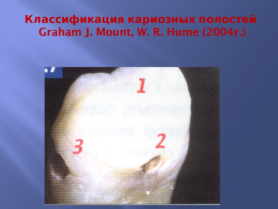 Классификация кариозных полостей Graham J. Mount, W. R. Hume (2004г.)