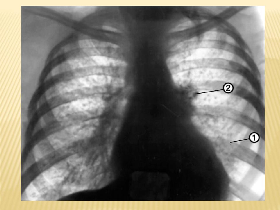 Передняя обзорная рентгенограмма органов грудной полости