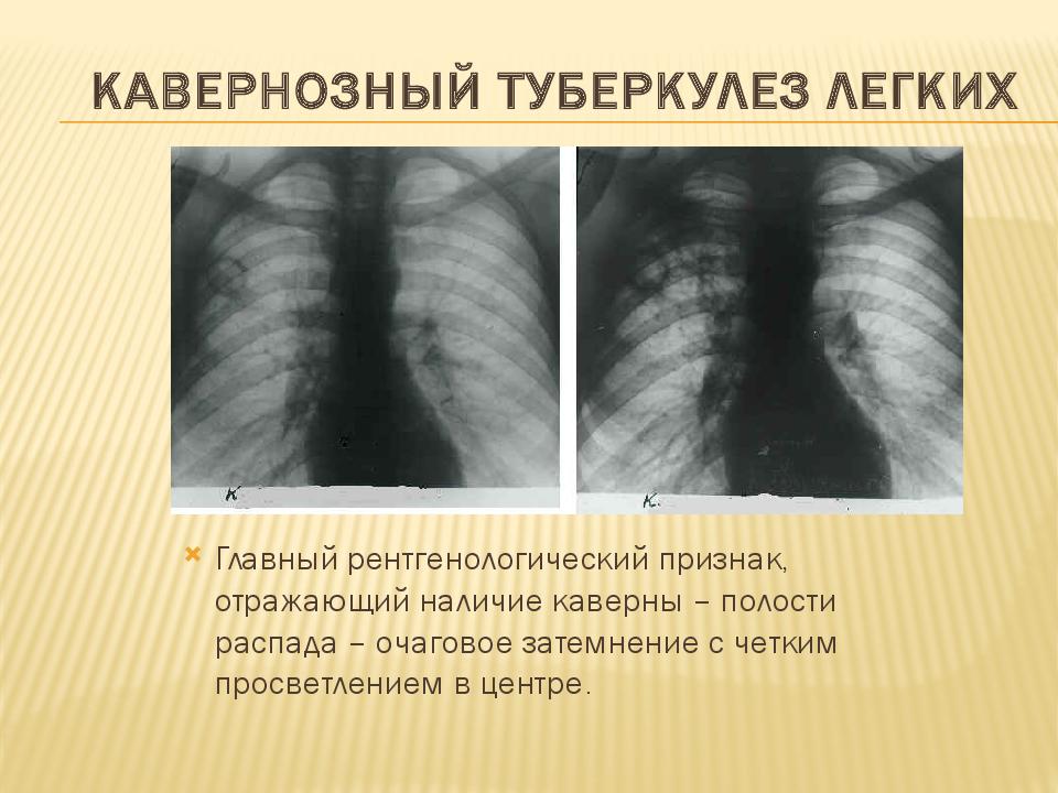 Кавернозный туберкулез легких