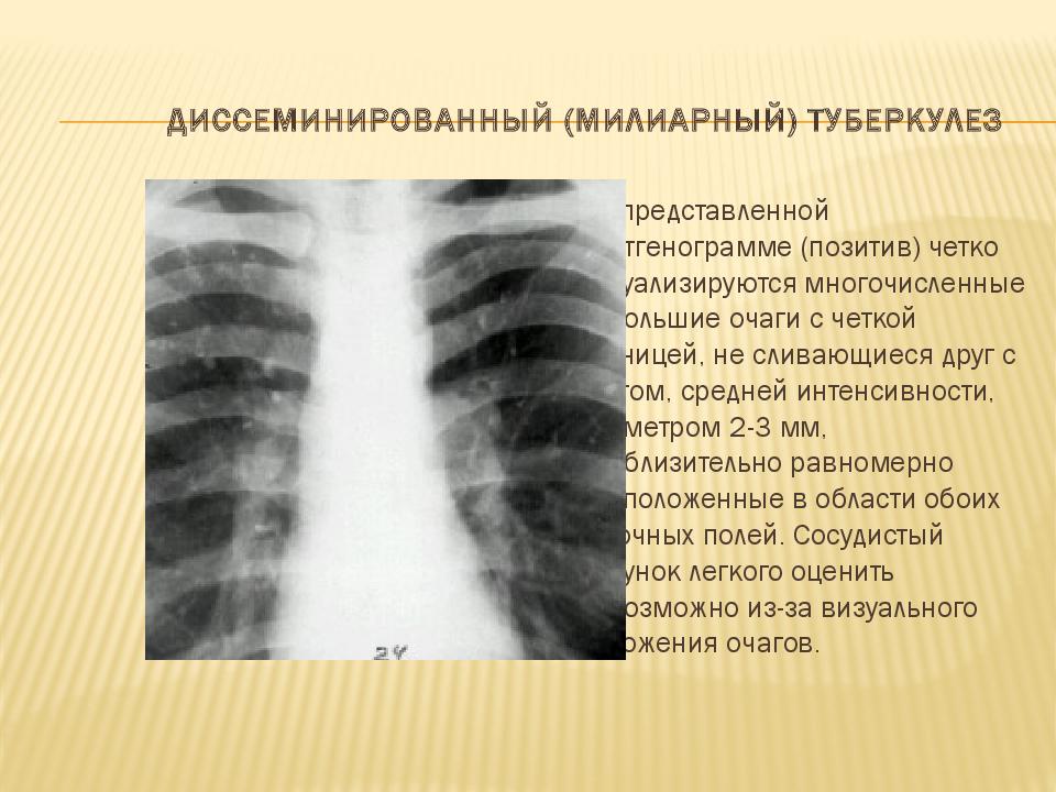 Диссеминированный (милиарный) туберкулез