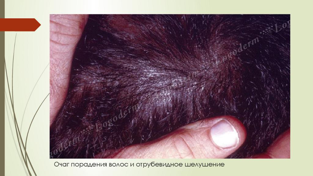Очаг порадения волос и отрубевидное шелушение