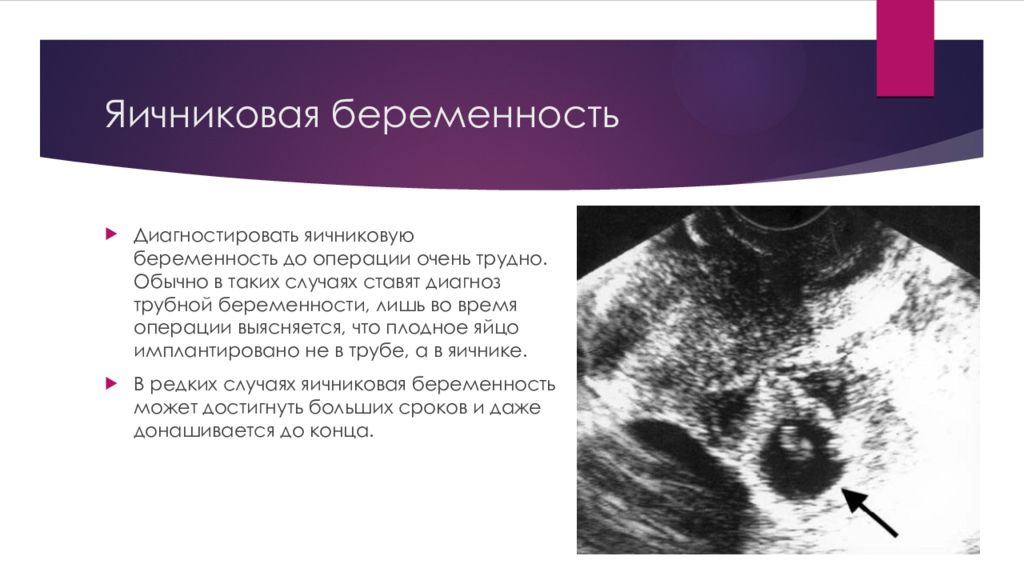 Эктопическая беременность презентация