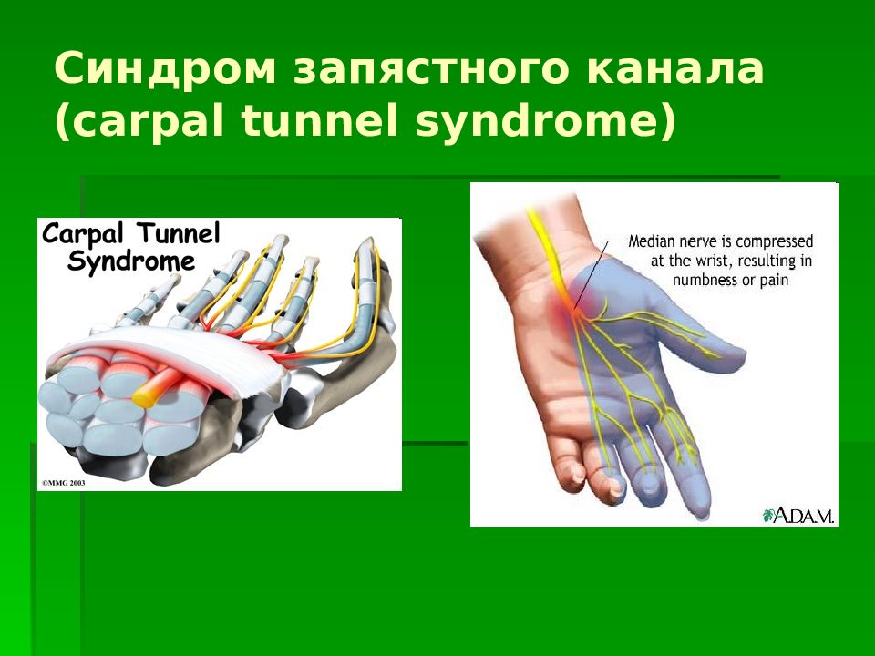 Ð¡Ð»Ð°Ð¹Ð´ 13: Ð¡Ð¸Ð½Ð´Ñ€Ð¾Ð¼ Ð·Ð°Ð¿Ñ�Ñ�Ñ‚Ð½Ð¾Ð³Ð¾ ÐºÐ°Ð½Ð°Ð»Ð° (carpal tunnel syndrome). 