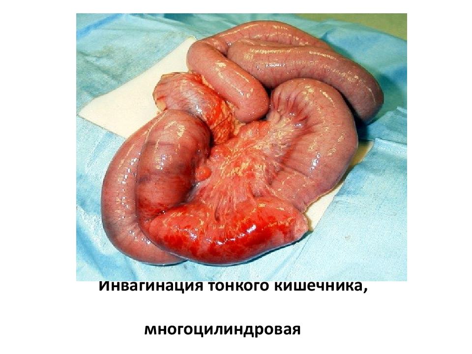 Инвагинация тонкого кишечника, многоцилиндровая