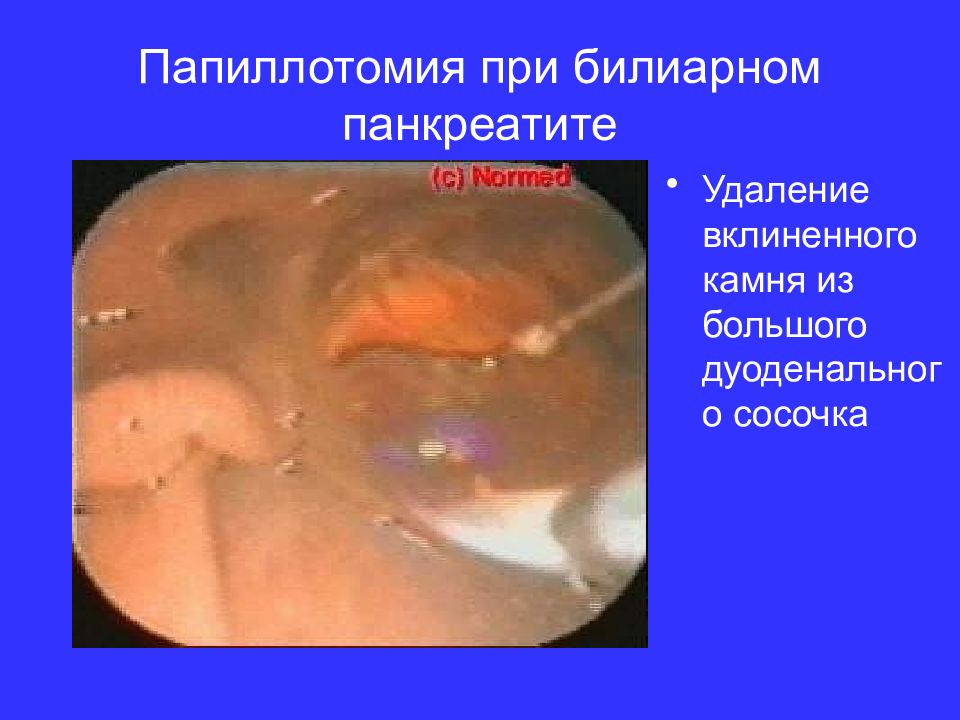 Папиллотомия при билиарном панкреатите