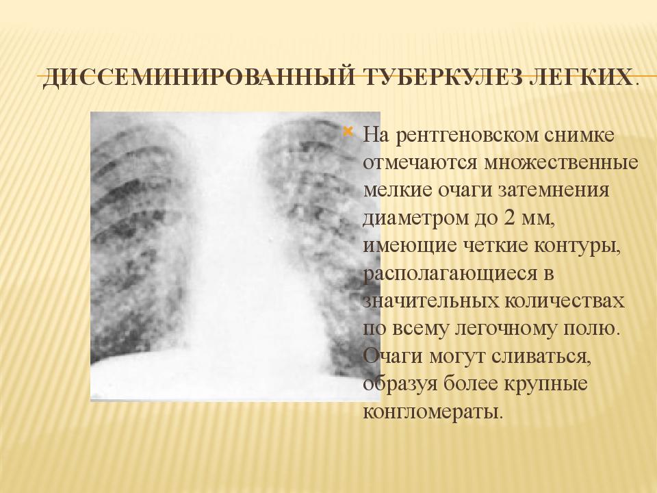 Диссеминированный туберкулез легких.