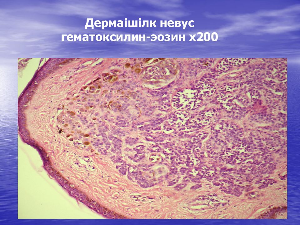 Дермаішілк невус гематоксилин-эозин х200