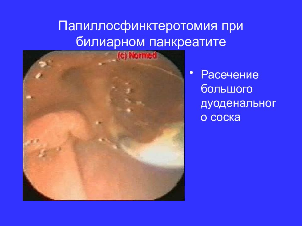 Папиллосфинктеротомия при билиарном панкреатите