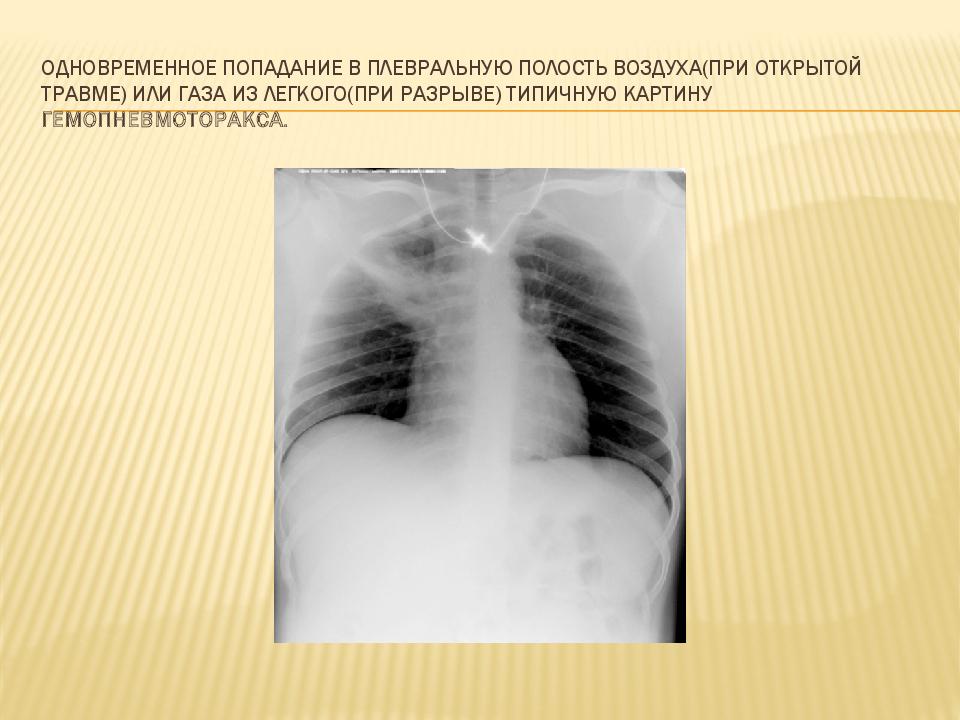 Одновременное попадание в плевральную полость воздуха(при открытой травме) или газа из легкого(при разрыве) типичную картину гемопневмоторакса.