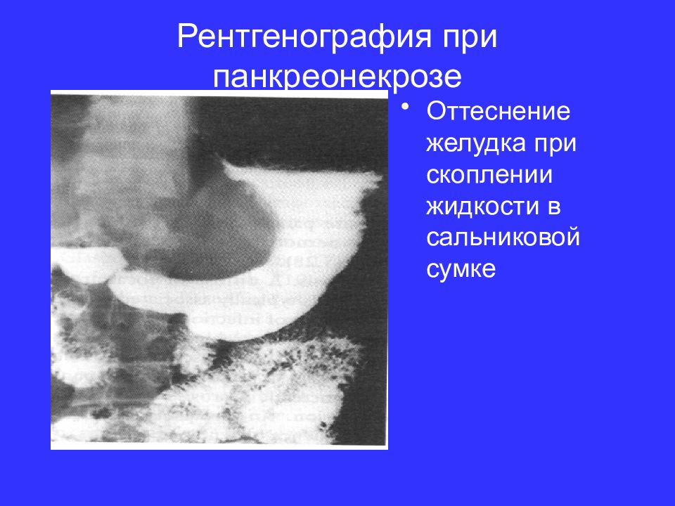 Рентгенография при панкреонекрозе