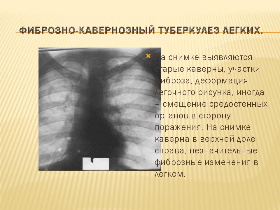 Фиброзно-кавернозный туберкулез легких.