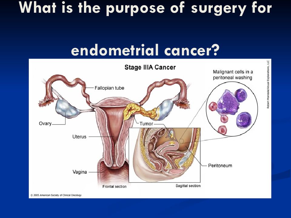 endometrium rák mirena