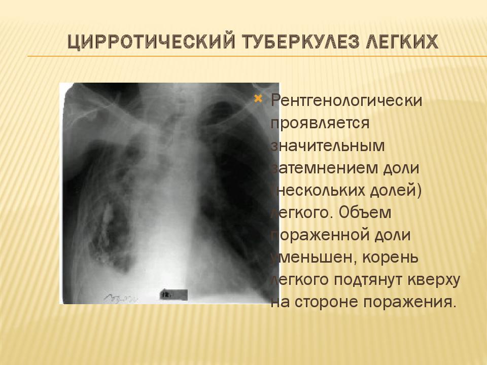Цирротический туберкулез легких