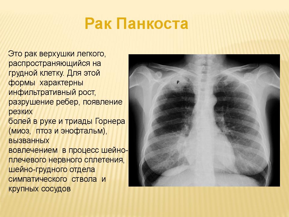 Передняя обзорная рентгенограмма органов грудной полости